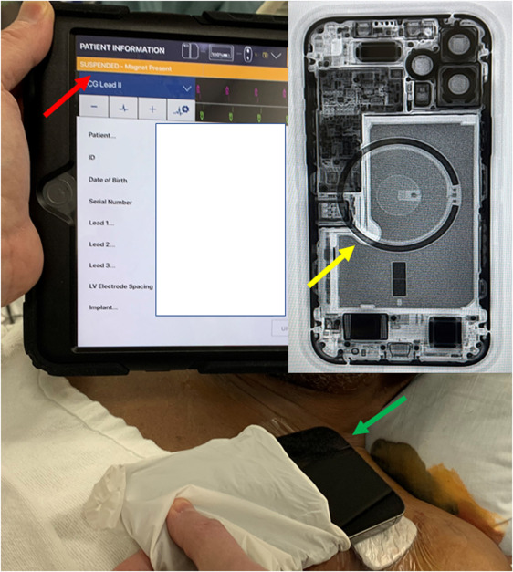 The ICD shuts down due to the presence of a magnet on the back of the iPhone 12. Photo: British Heart Rhythm Society